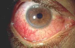 Augen-Uveitis - Behandlung, Symptome, Behandlung