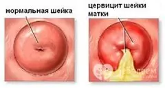 Cervicitis