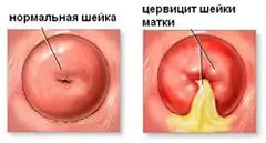 Цервицит - лечение, симптоми, причини