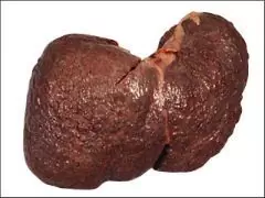 Ciroza Hepatică - Simptome, Etape, Metode De Diagnostic, Tratament