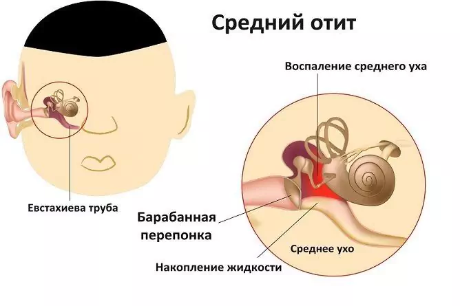 Отит на средното ухо - симптоми, лечение на уши, диагностика при деца