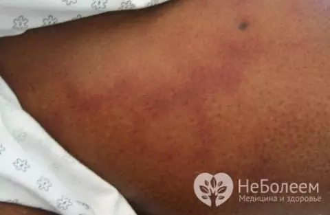 Gejala Strongyloidosis di bawah kulit