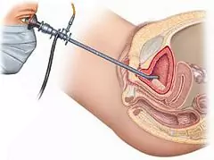 Cystoscopy - Contraindications, Consequences