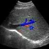 Mengapa Anda Memerlukan Ultrasound Saluran Darah