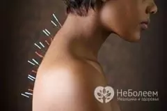 Acupuncture is an ancient healing practice of oriental medicine