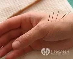 Su jok acupuncture - treatment of various diseases through specific points on the palms of the hands and feet