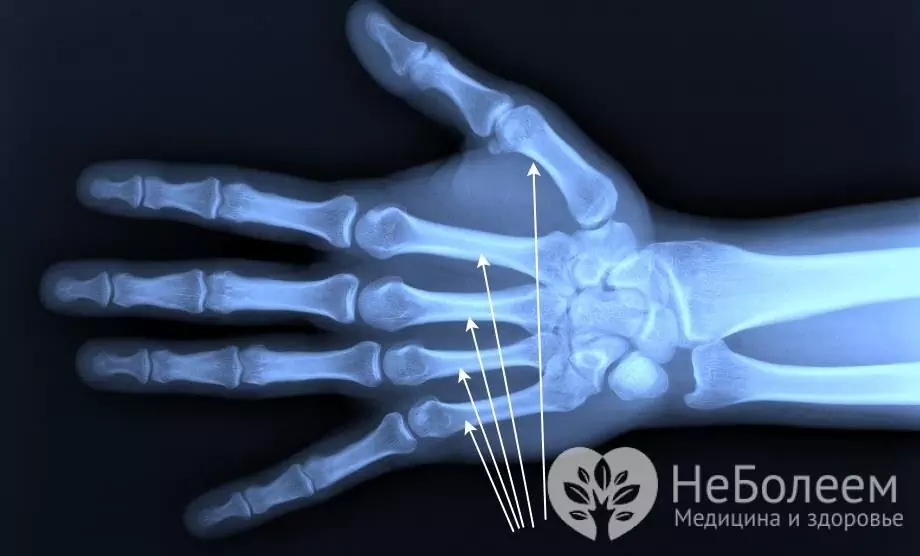 Metacarpal bein