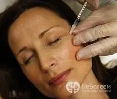 Atjauninimo procedūra atliekant Botox injekcijas