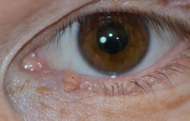 Papilloma On The Eyelid: Photo, Removal, Causes Of Appearance