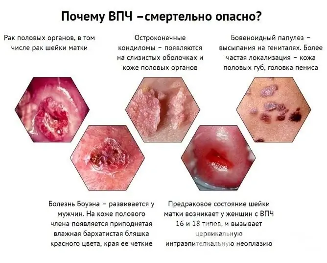 Papilloma vagina menimbulkan bahaya berkaitan dengan kemungkinan degenerasi menjadi barah