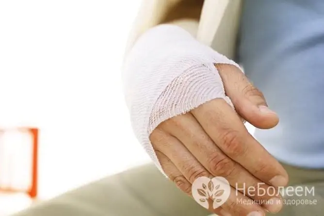 Secondary osteoarthritis can occur due to prior injuries to the wrist