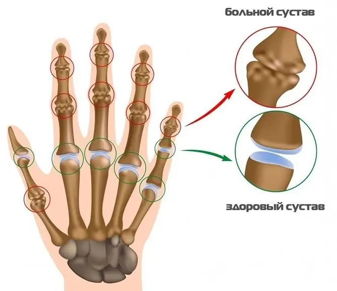 Gradual deformation of the joints leads to the appearance of severe symptoms