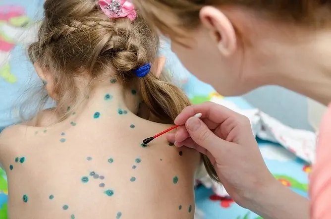 The Incubation Period Of Chickenpox: How Many Days Does It Take In Adults And Children