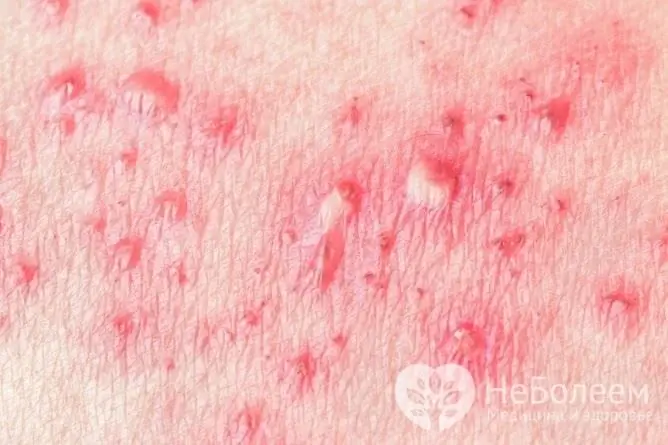 The disease is characterized by an itchy rash