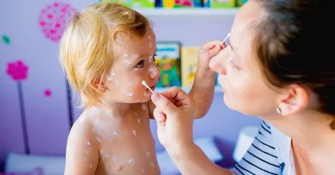 Remedies For Chickenpox: A List Of The Best Drugs, Doctor's Advice