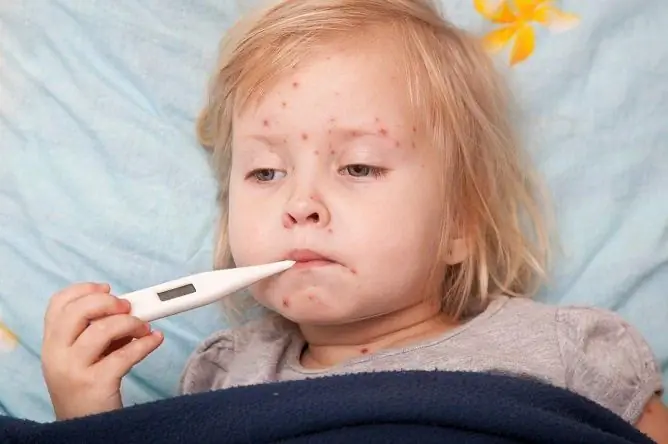 Chickenpox Without Fever In Children And Adults: Is It Possible, Treatment