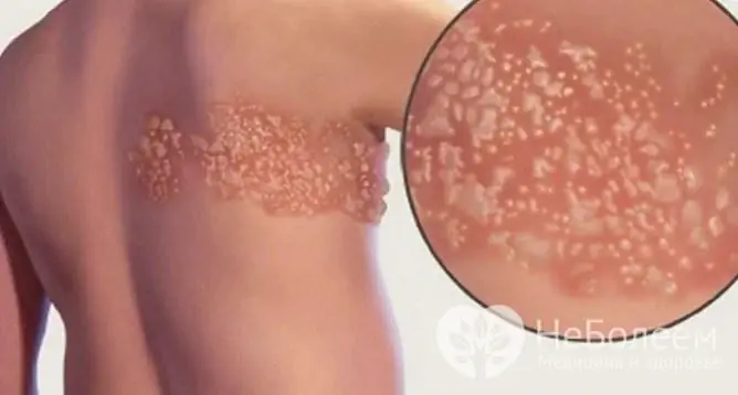 Shingles is a variant of the disease caused by the varicella-zoster virus