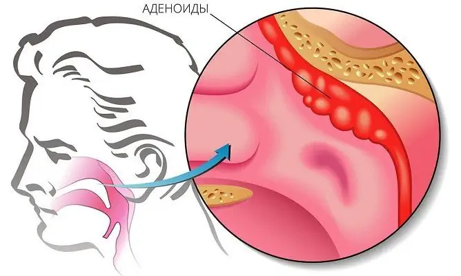 Adenoidų Gydymas: Kaip Ir Ką Gydyti Suaugusiems, Gydymo Režimas, Apžvalgos