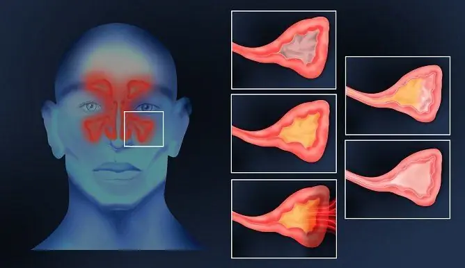 Apakah Mungkin Menghangatkan Hidung Anda Dengan Sinusitis Dengan Garam Dan Telur, Lampu Biru Dan Merah