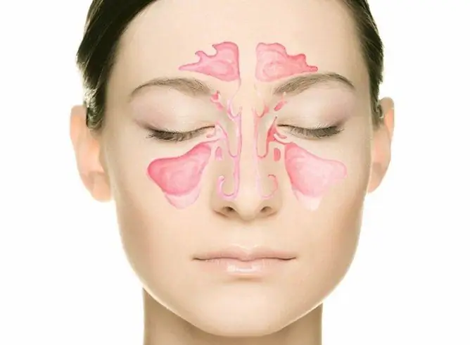 Treatment Of Sinusitis With Folk Remedies At Home: Methods