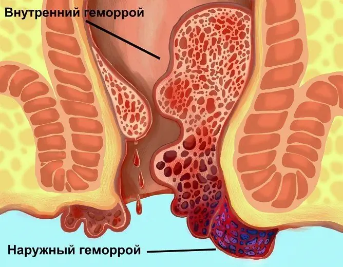 Hämorrhoiden: Behandlung Zu Hause, Methoden