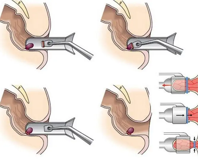 Anillos De Látex Para Hemorroides: Revisiones, Ligadura De Hemorroides