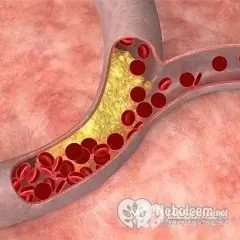 Cholesterolio dieta padeda sumažinti cholesterolio kiekį kraujyje