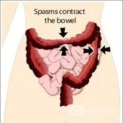 Síndrome do intestino irritável - o que é?