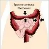 Irritable Bowel Syndrome - What Is It?