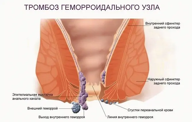 Posledice Hemoroidov Pri Moških In ženskah: Kaj Se Bo Zgodilo, če Se Ne Zdravijo