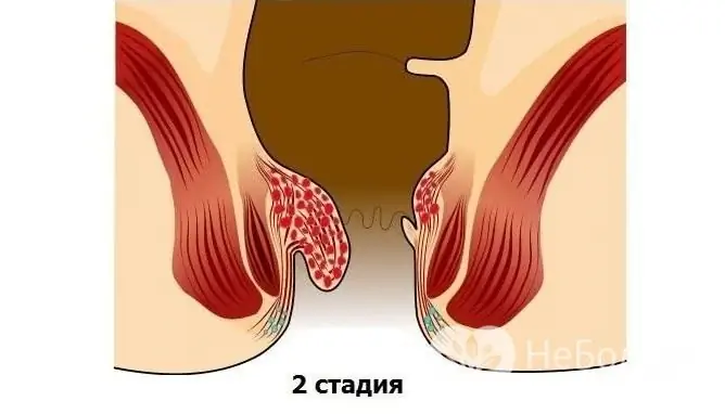 În acest stadiu, hemoroizii pot fi tratați cu remedii conservatoare