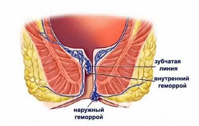 Le emorroidi interne nella seconda fase potrebbero non manifestarsi in qualcosa di diverso dal sanguinamento rettale minore