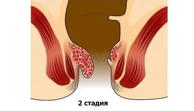 Hemorrhoids 2 Degrees: Treatment Without Surgery, Symptoms, Photos, Doctor's Advice