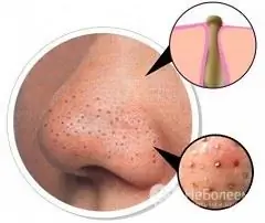 Blackheads on the face - how to deal with them?