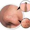 Blackheads On The Face - How To Deal With Them?