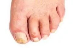 Effective remedies against nail fungus