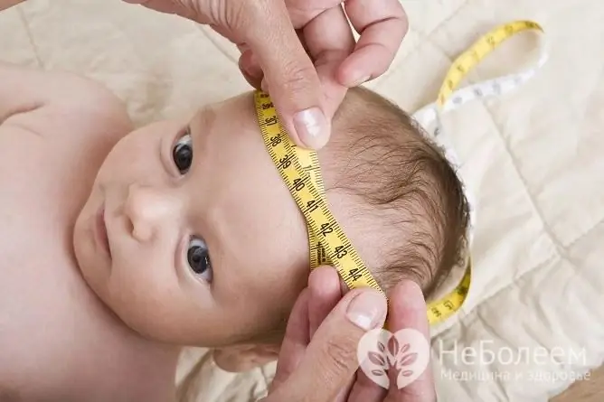 Intracranial hypertension in infants is manifested by an increase in the head