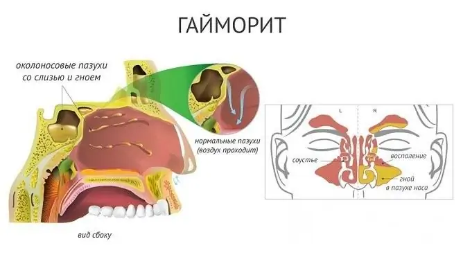 Използването на антибактериални аерозоли ви позволява да потискате патогенната флора в максиларните синуси