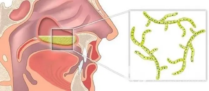 L'uso di farmaci ad azione antifungina è indicato per le lesioni micotiche dei seni nasali