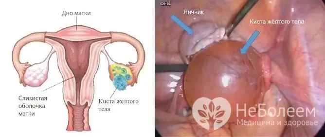 В повечето случаи лутеалната киста се решава сама, но понякога може да се наложи хирургично отстраняване