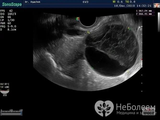 Corpus luteumcyste wordt gediagnosticeerd door middel van echografie