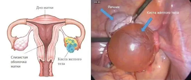 Kyste De L'ovaire Lutéal: Traitement, Causes, Diagnostic