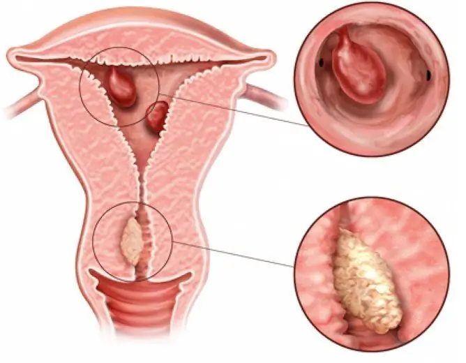 Polip Berserat Kelenjar Endometrium: Rawatan Selepas Penyingkiran