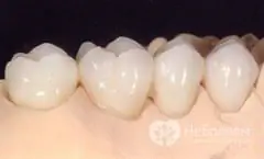 ¿Cuáles son los tipos de prótesis dentales?