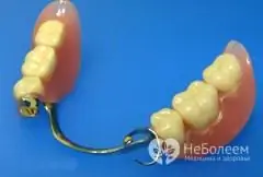 Tipos de próteses dentárias: removíveis e não removíveis