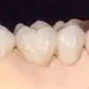 Tipos De Prótesis Dentales