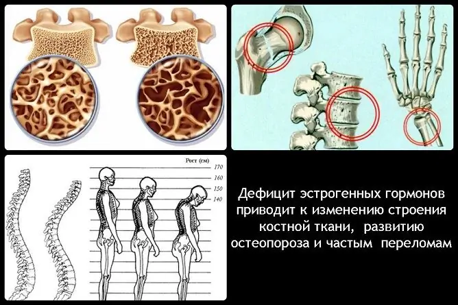 Липса на естроген при жените: симптоми, лечение