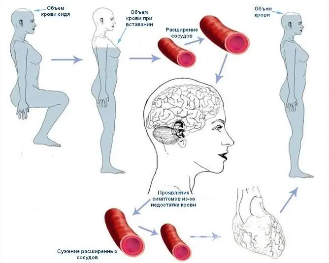 Hipotensiunea ortostatică în majoritatea cazurilor este cauzată de o schimbare bruscă a poziției corpului