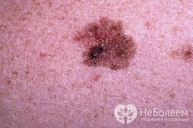 El melanoma puede no diferir de una marca de nacimiento normal, por lo que debe prestar atención a cualquier nueva marca de nacimiento