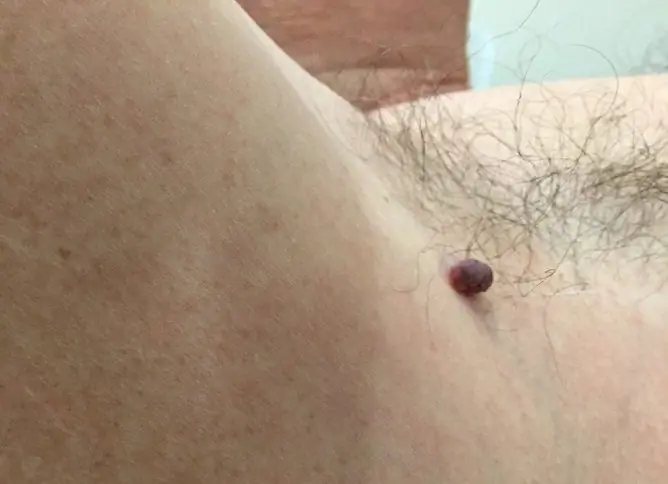 Hanging Moles: Photo, Removal, Causes Of Appearance On The Body